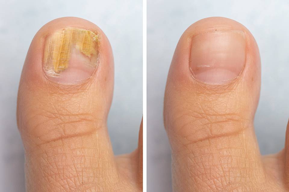verschreibungspflichtige medikamente gegen nagelpilz