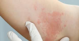 vitamin c allergie